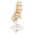 Lumbar Spinal Column with Dorso-Lateral Prolapsed Disc Anatomical Model T84892